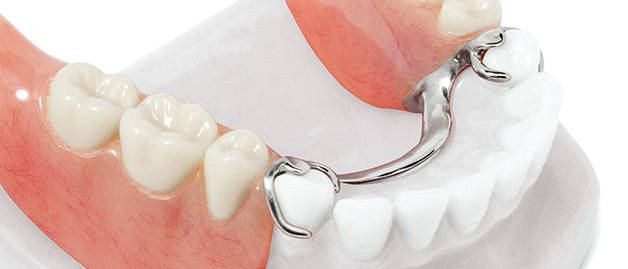 Плюсы несъемного протезирования зубов