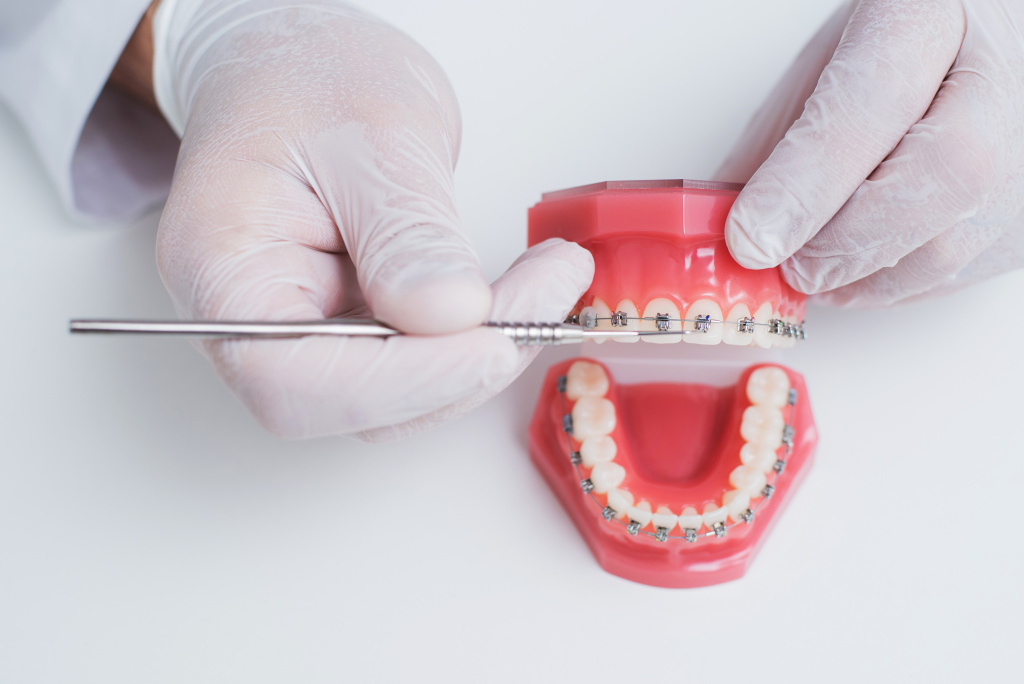Исправление прикуса и выравнивание зубов