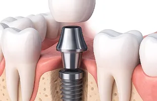 Двухэтапная имплантация