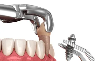 Одномоментная имплантация