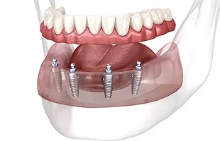 All-on-4 и All-on-6
