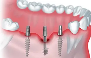 Базальная имплантация